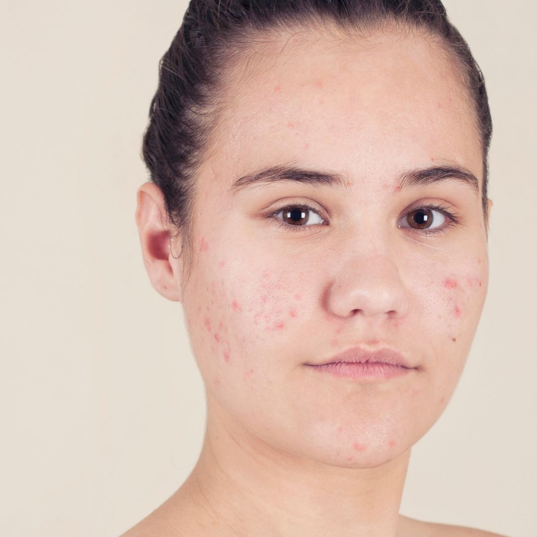 Person with acne