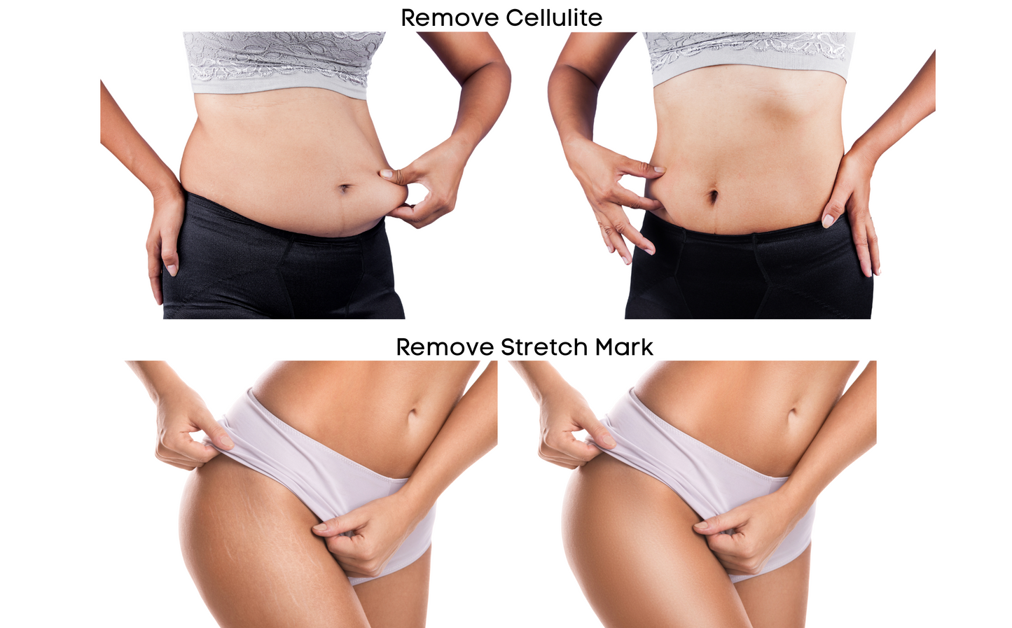 Before and after results of LUFFCABO body massager for cellulite and stretch mark removal